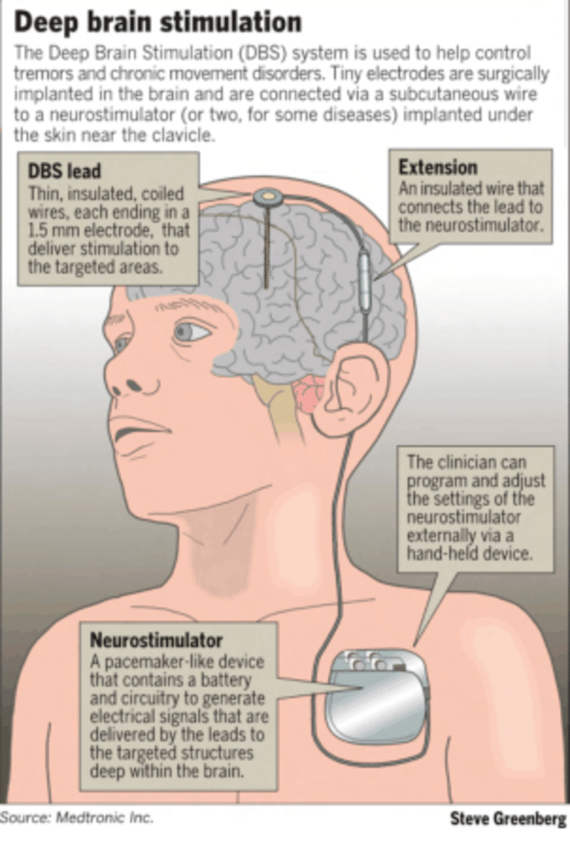 2 A Deep Brain Stimulation implant.