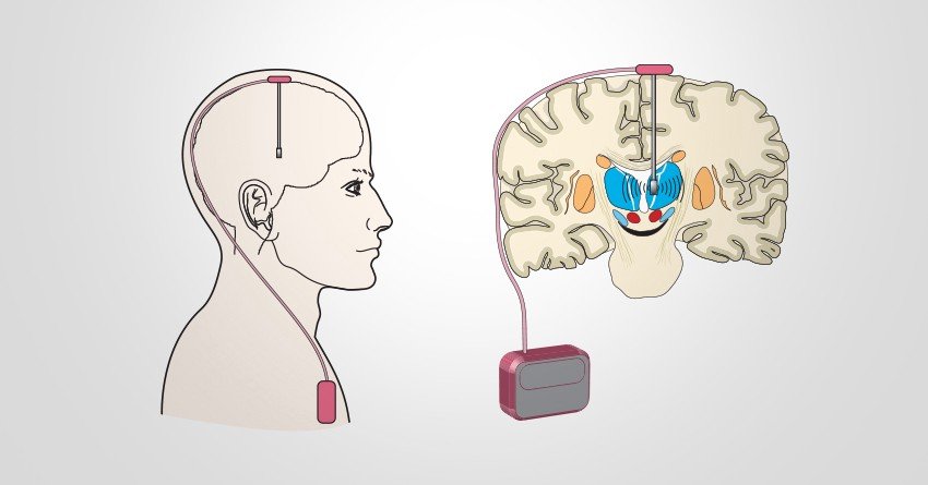 Deep brain stimulation for Parkinsons Disease and ...