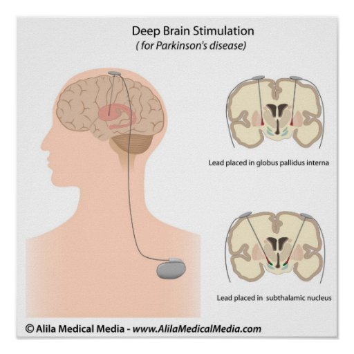 Deep brain stimulation for Parkinson
