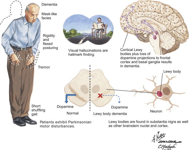 Dementia with Lewy Bodies (Including Parkinsonâ€™s Disease ...