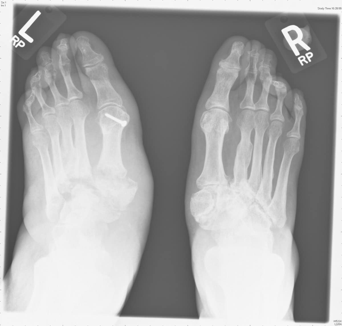 A case of charcot