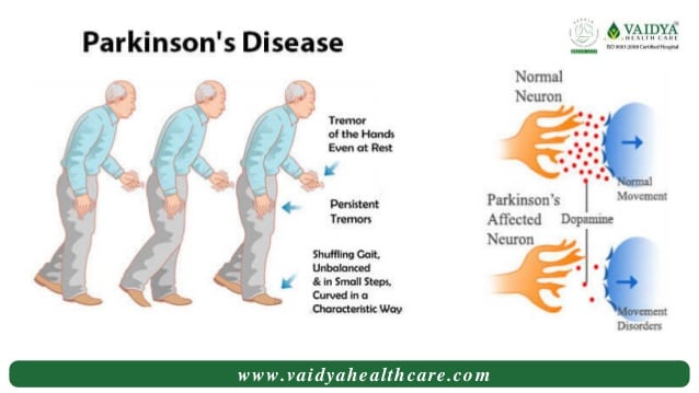 Ayurvedic Treatment For Parkinsons Disease Kerala ...