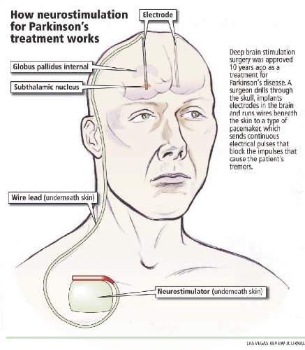 Brain surgery helps Parkinsons patient control symptoms