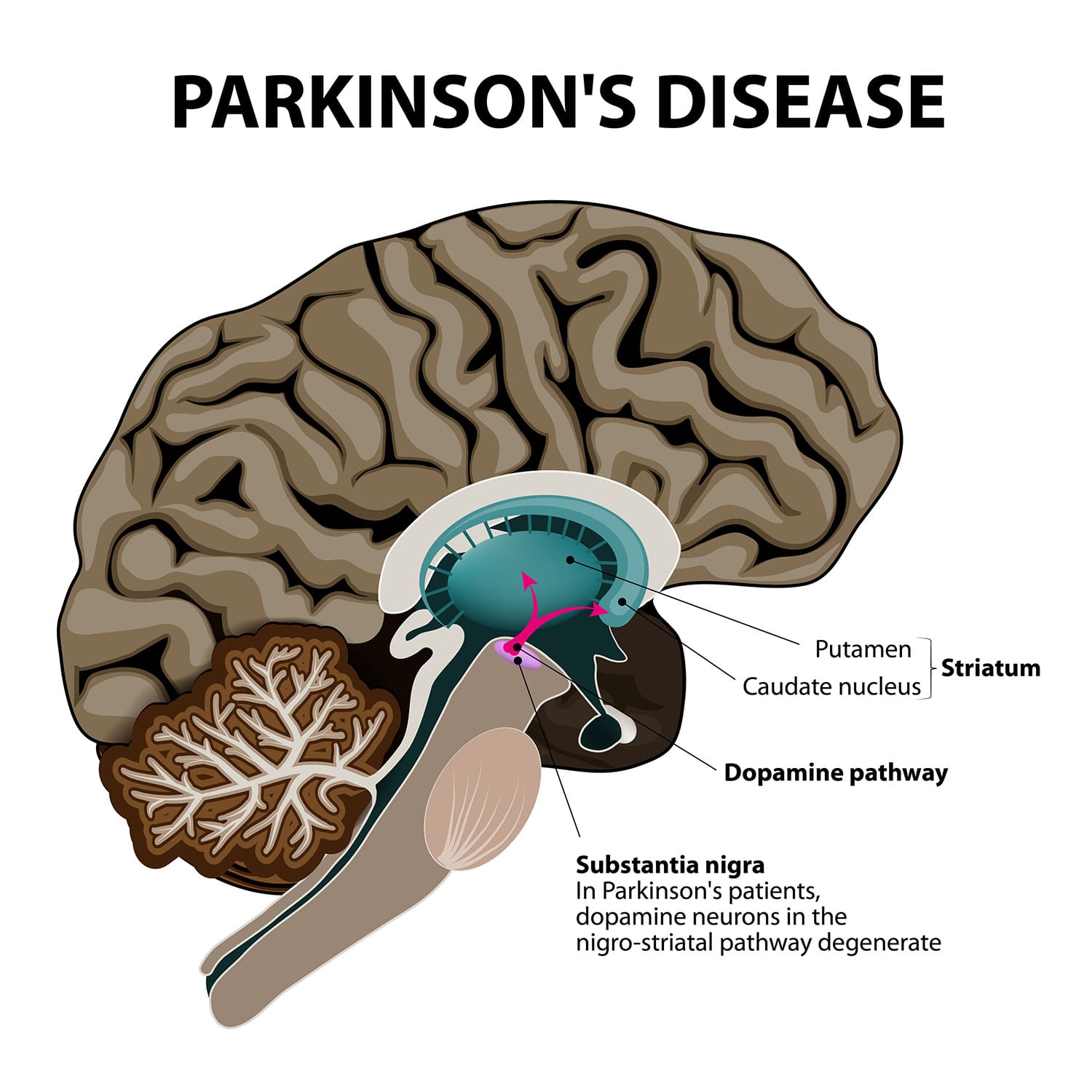 Cannabis and Parkinson