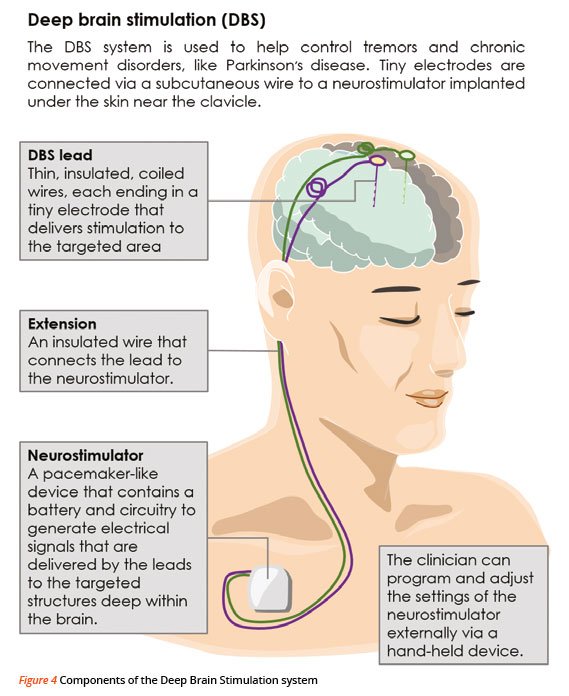 Components of Deep Brain Stimulation System