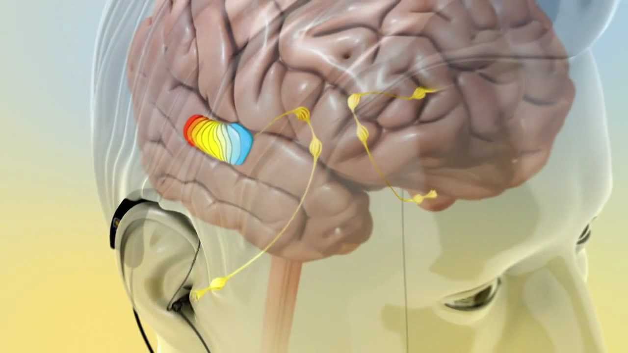 Conditions – Tinnitus – NeuroSpa Brain Rejuvenation Center