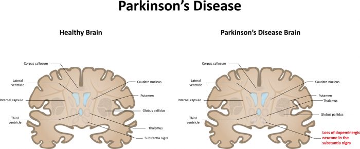 Could "Advanced Probiotics" Soon Treat Parkinson