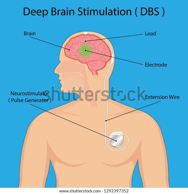 Deep Brain Stimulation Dbs Parkinsons Disease Stock Vector (Royalty ...