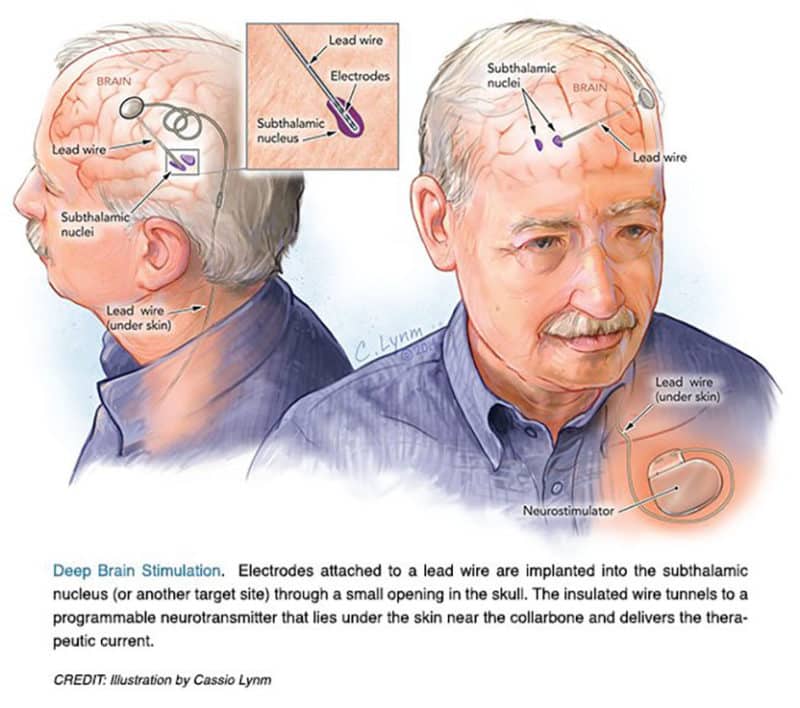 Deep brain stimulation for Parkinsonâs disease
