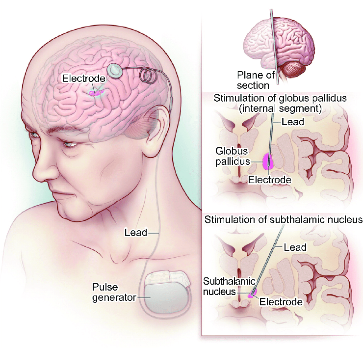 Deep brain stimulation for Parkinson