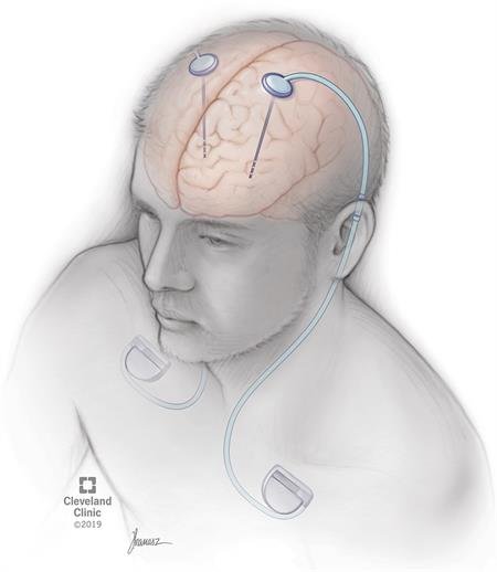 Deep Brain Stimulation for Parkinson