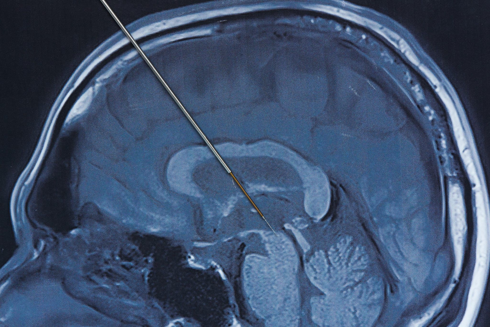 Deep Brain Stimulation for Parkinsons » Fort Worth ...