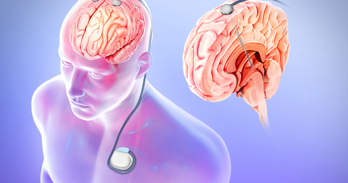 Deep Brain Stimulation Treatment Cost in India