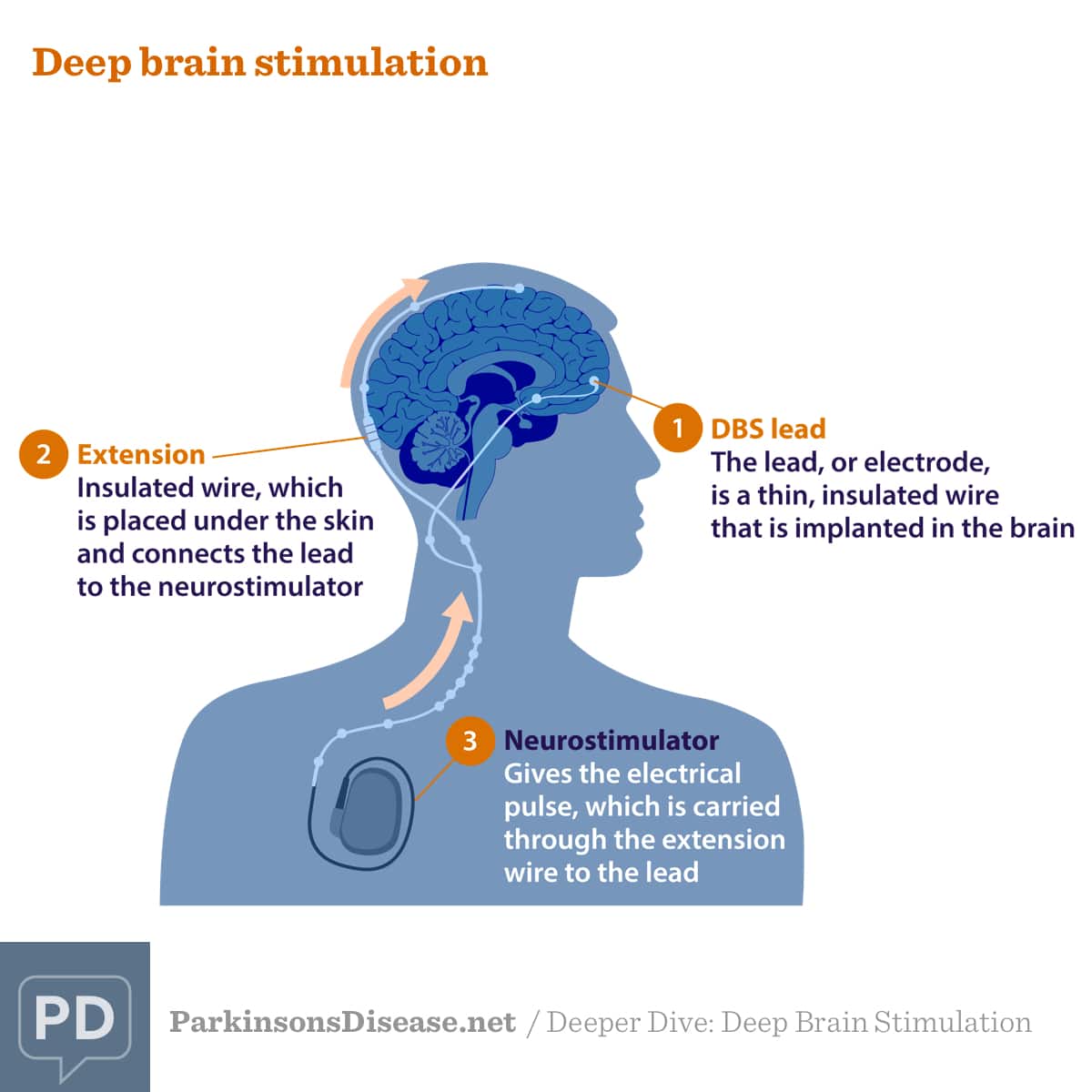 Deeper Dive: Deep Brain Stimulation