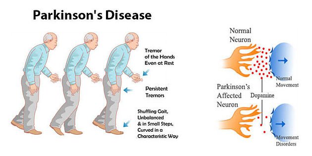 Early Intense Exercise Delays Parkinson