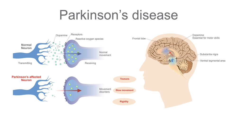 How Do You Get Diagnosed With Parkinson