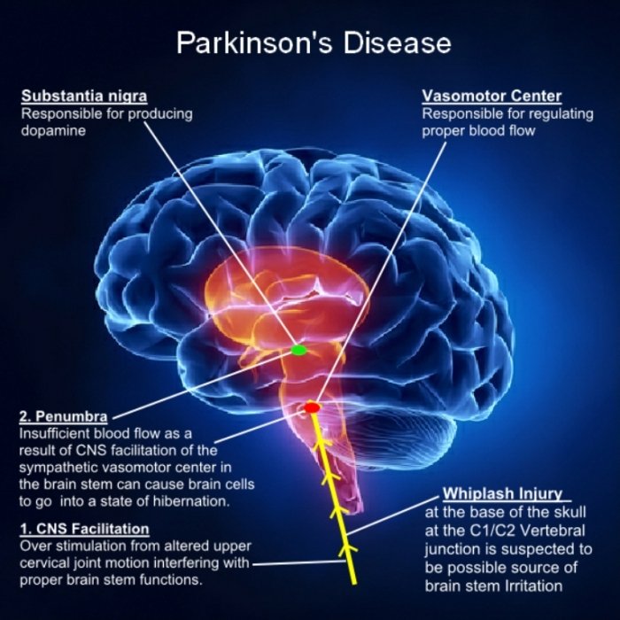 How To Cure and What To Avoid in Parkinsons Disease ...