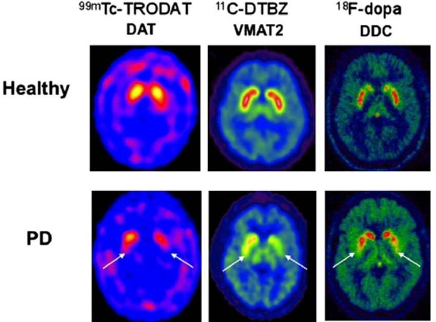 Imaging dopamine terminal function in healthy controls and ...