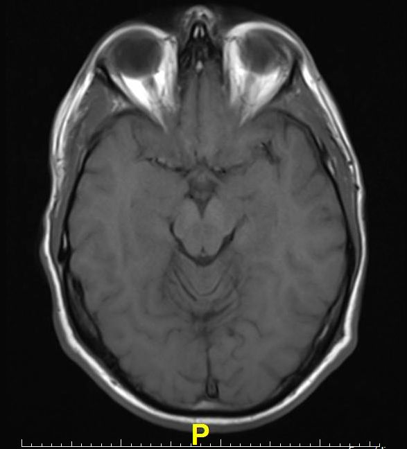 MRI Brain Scans Detect People With Early Parkinson