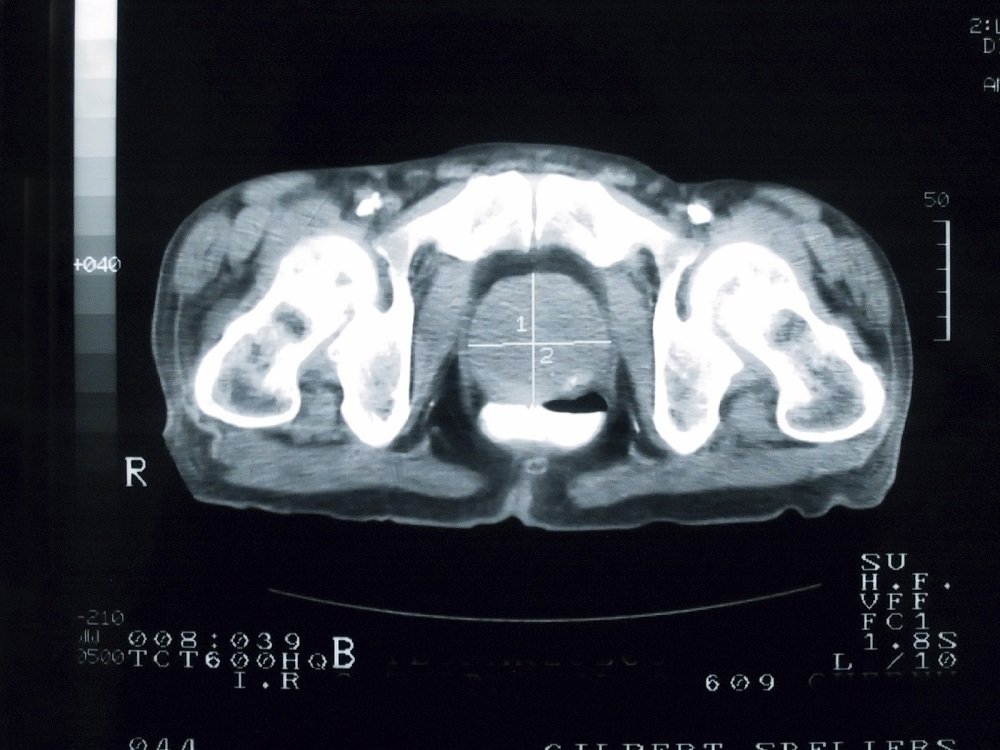 MRI Predicts Outcomes of Prostate Cancer Salvage ...