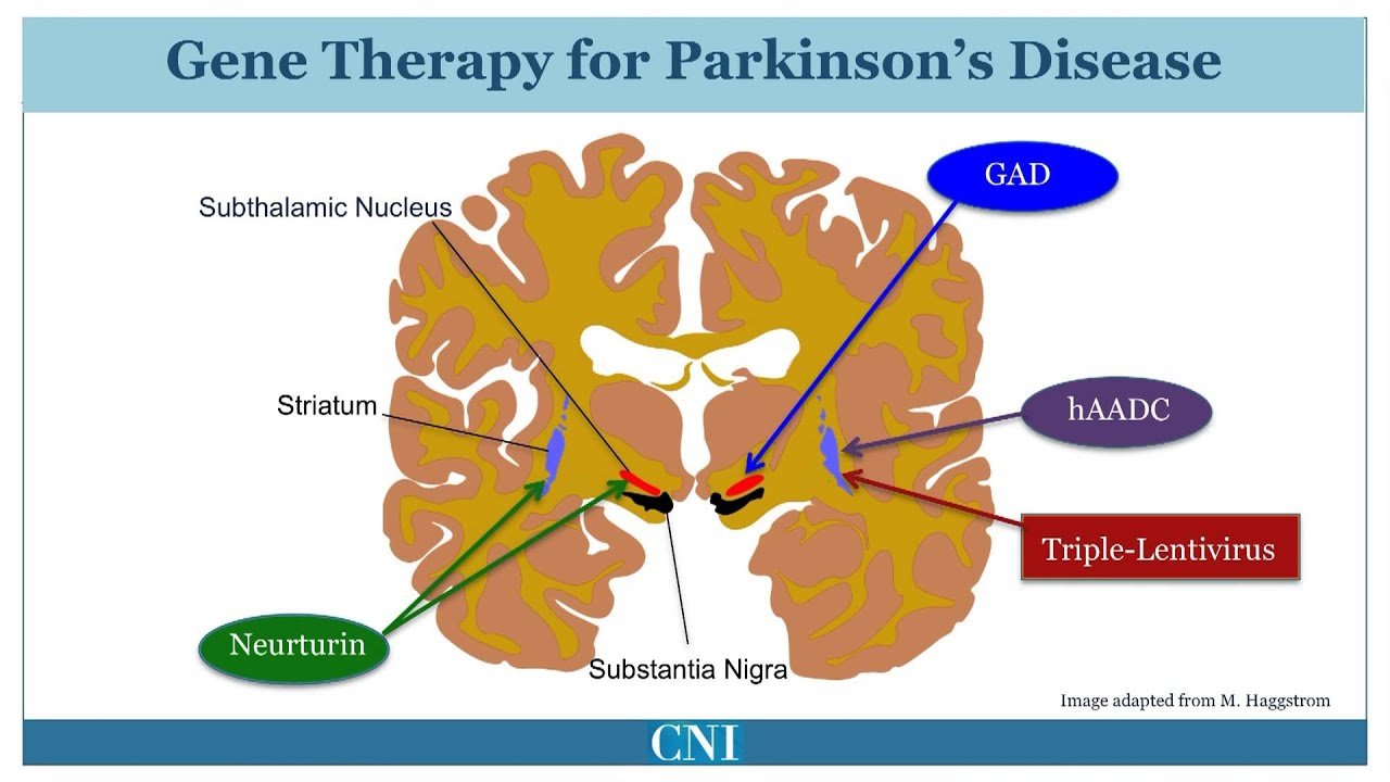 New Treatment: Symptomatic Treatment of Parkinson