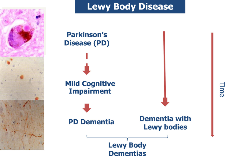 Nomenclature of Lewy body diseases. Parkinson’s disease ...