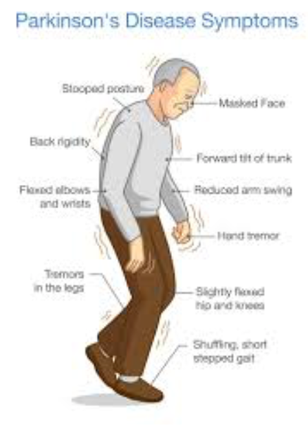 Occupational Therapy for Parkinsonâs Disease