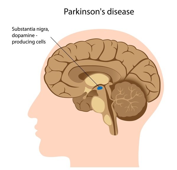 Parkinson disease: MedlinePlus Genetics