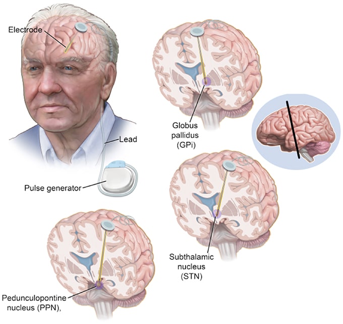 Parkinson Disease Treatment Brain Surgery