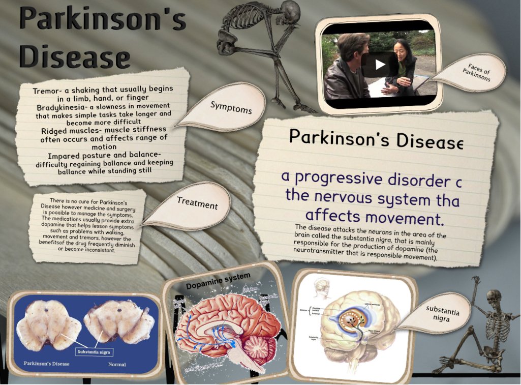 Parkinson´s Disease: brain, disorder, en, fitness, health ...