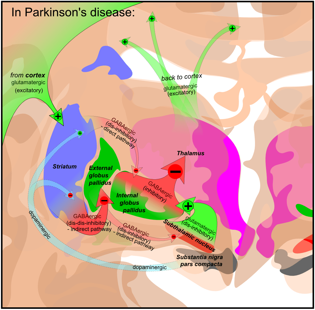 Parkinsonâs disease