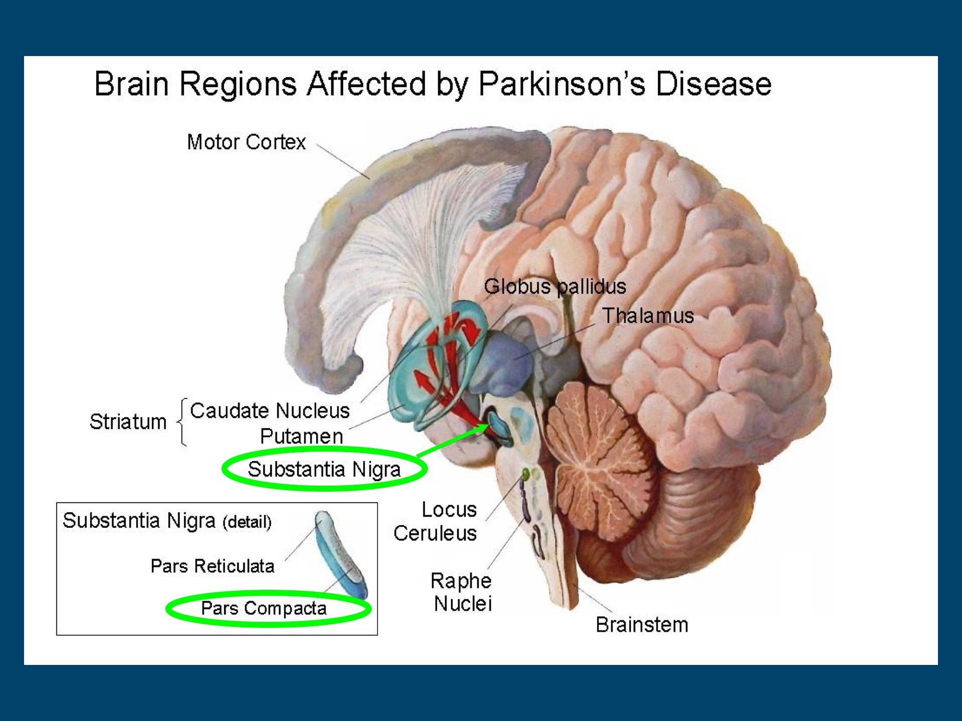 Parkinsons Disease Brain Area