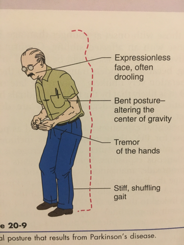 Parkinsons Disease Causes A Shuffling Gait And A Mask Like ...
