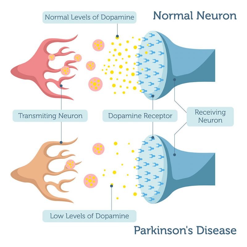 Parkinsons Disease DNA Test  DNA Access Lab