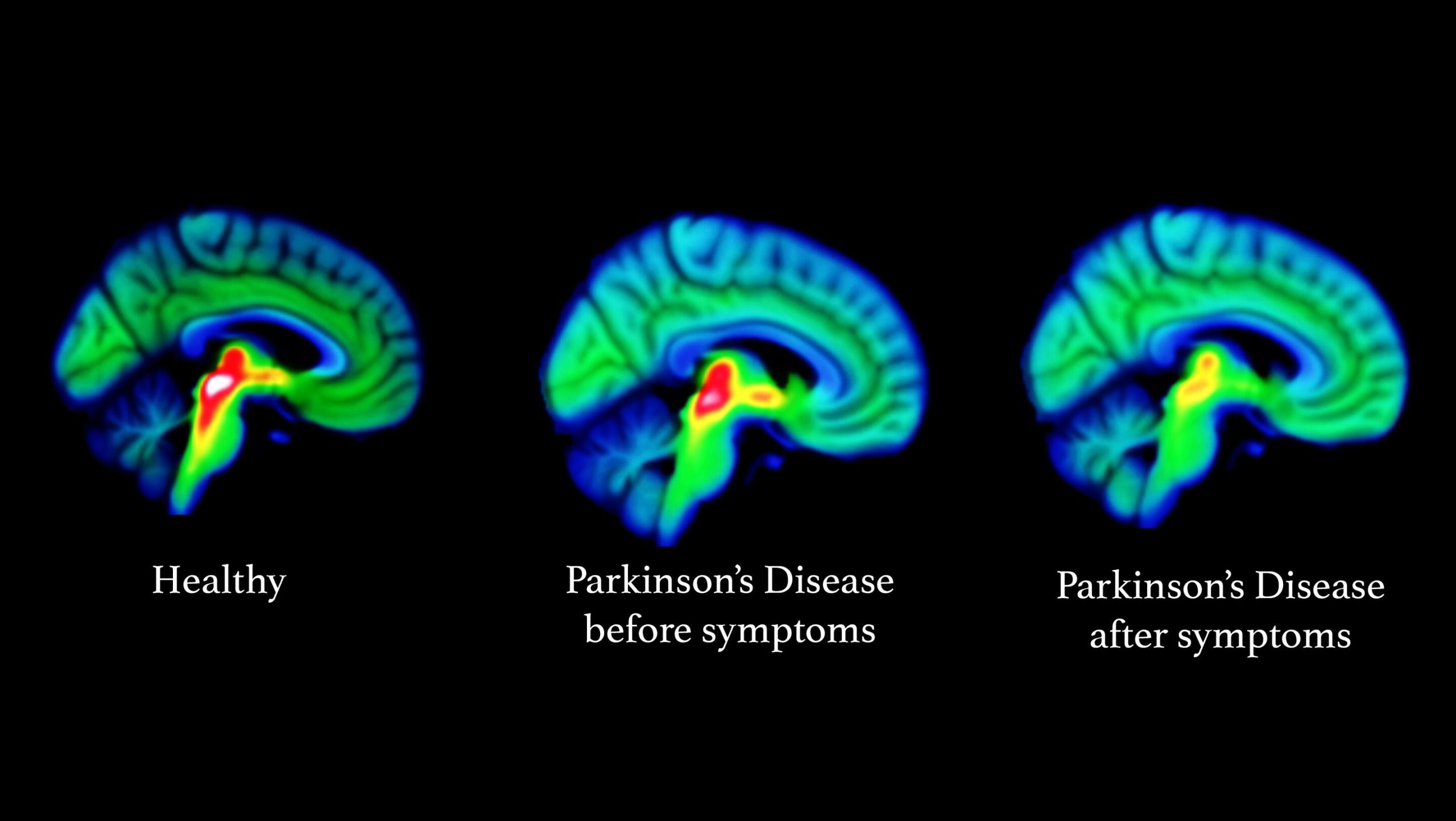 Study reveals roots of Parkinson