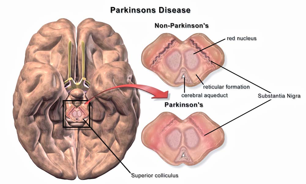 The Hidden Link Between Meth & Parkinson’s Disease