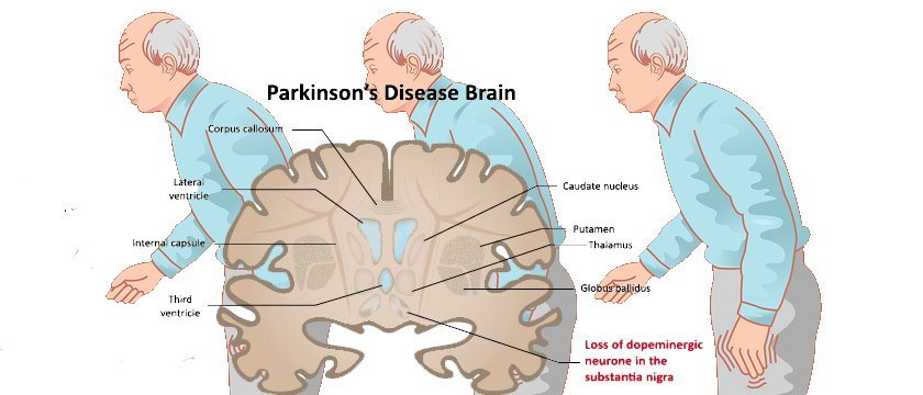 What Does Parkinson