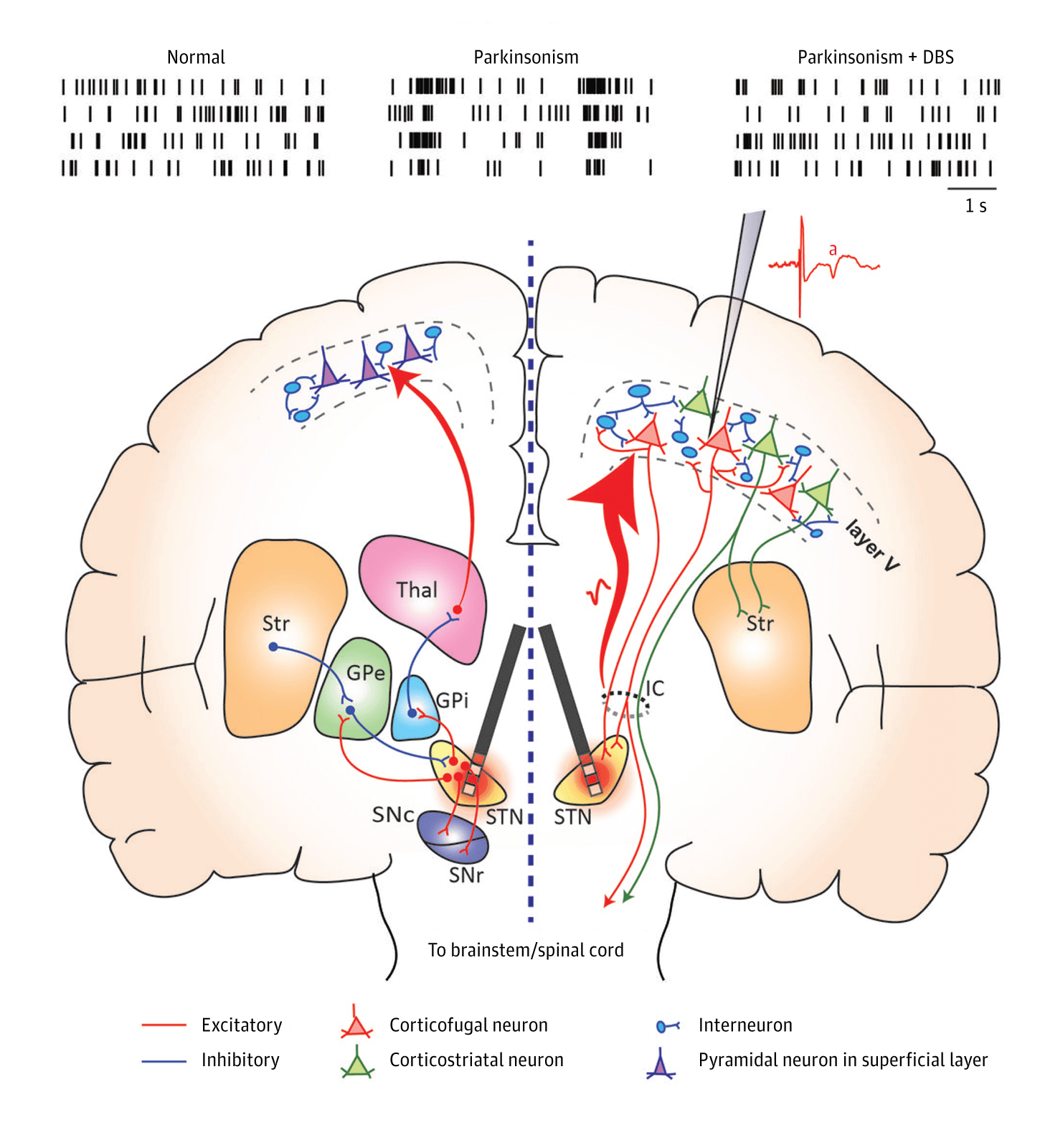 What Is Deep Brain Stimulation For Parkinson